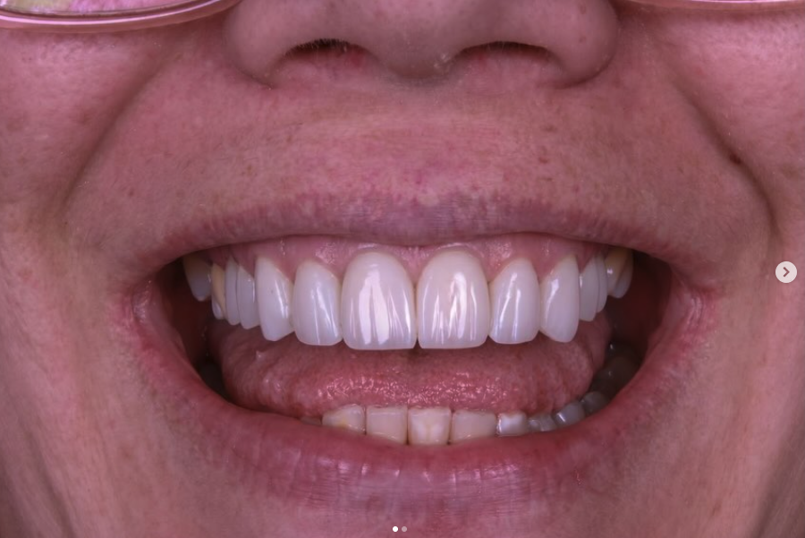 Resultado clareamento dental