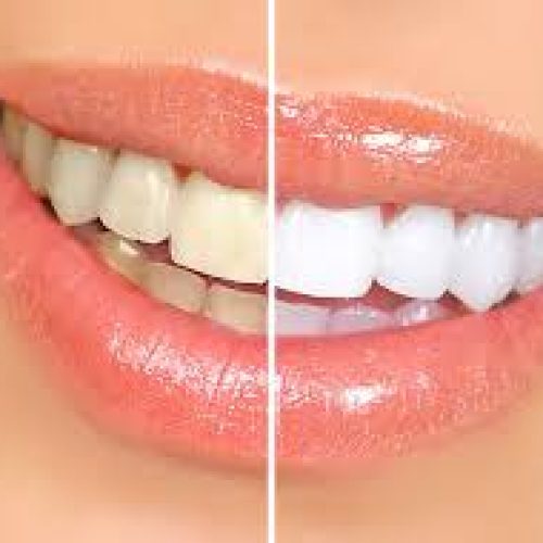 clareamento-dental.jpeg